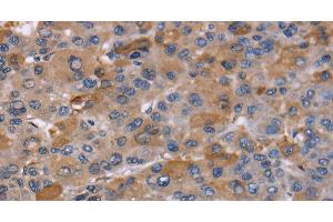 Immunohistochemistry of paraffin-embedded Human liver cancer using NCF2 Polyclonal Antibody at dilution of 1:60 (NCF2 Antikörper)