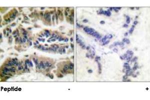 Immunohistochemical analysis of paraffin-embedded human breast carcinoma tissue using CASP6 polyclonal antibody . (Caspase 6 Antikörper)