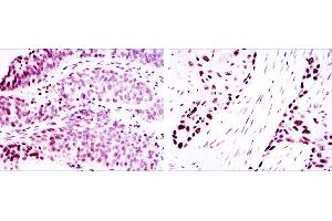 Immunohistochemical analysis of paraffin-embedded ovarian cancer (left) and lung cancer (right) using p63α mouse mAb with DAB staining. (p63alpha Antikörper)