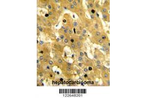 Formalin-fixed and paraffin-embedded human hepatocarcinoma reacted with SCP2 Antibody (Center), which was peroxidase-conjugated to the secondary antibody, followed by DAB staining. (SCP2 Antikörper  (Middle Region))