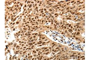 The image on the left is immunohistochemistry of paraffin-embedded Human ovarian cancer tissue using ABIN7131160(SPATA2L Antibody) at dilution 1/30, on the right is treated with fusion protein. (SPATA2L Antikörper)