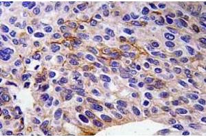 Immunohistochemistry (IHC) analyzes of SEMA3A antibody in paraffin-embedded human lung carcinoma tissue. (SEMA3A Antikörper)