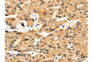 The image on the left is immunohistochemistry of paraffin-embedded Human liver cancer tissue using ABIN7131243(STX8 Antibody) at dilution 1/35, on the right is treated with fusion protein. (STX8 Antikörper)