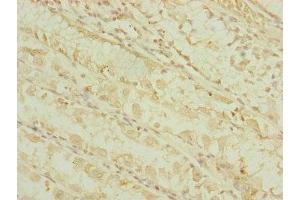 Immunohistochemistry of paraffin-embedded human gastric cancer using ABIN7164317 at dilution of 1:100 (DHTKD1 Antikörper  (AA 1-280))