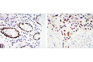 Immunohistochemical analysis of paraffin-embedded colon cancer tissues (left) and lung cancer tissues (right) using KLF4 mouse mAb with DAB staining (KLF4 Antikörper)