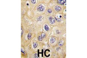 Formalin-fixed and paraffin-embedded human hepatocellular carcinoma reacted with CLDN1 polyclonal antibody  , which was peroxidase-conjugated to the secondary antibody, followed by DAB staining.