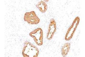 Formalin-fixed, paraffin-embedded human Prostate Carcinoma stained with PSA Mouse Monoclonal Antibody (A67-B/E3). (Prostate Specific Antigen Antikörper)