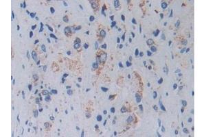 Detection of TOP3 in Human Prostate cancer Tissue using Polyclonal Antibody to Topoisomerase III (TOP3)
