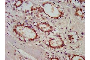 IHC image of ABIN7154777 diluted at 1:800 and staining in paraffin-embedded human breast cancer performed on a Leica BondTM system. (GBP4 Antikörper  (AA 494-603))