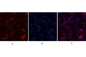 Immunofluorescence analysis of human breast cancer tissue. (Caspase 7 Antikörper  (AA 160-240))