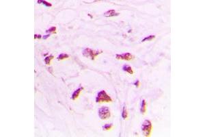 Immunohistochemical analysis of STK17B staining in human lung cancer formalin fixed paraffin embedded tissue section. (DRAK2 Antikörper  (Center))
