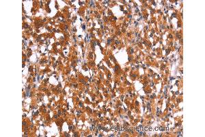 Immunohistochemistry of Human thyroid cancer using HMGCS2 Polyclonal Antibody at dilution of 1:40