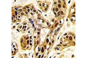 IHC analysis of FFPE human breast carcinoma tissue stained with PRMT1 antibody (PRMT1 Antikörper  (AA 317-346))