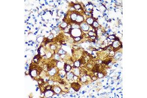 Immunohistochemistry of paraffin-embedded Human breast cancer using WIF1 Rabbit pAb (ABIN6128926, ABIN6150217, ABIN6150219 and ABIN6216799) at dilution of 1:100 (40x lens).