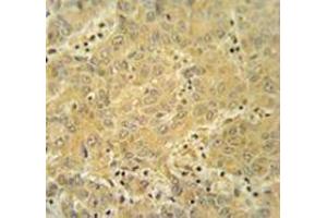 Immunohistochemistry analysis in human hepatocarcinoma tissue (Formalin-fixed, Paraffin-embedded) using CYP2A7  Antibody , followed by peroxidase conjugation of the secondary antibody and DAB staining. (CYP2A7 Antikörper  (Middle Region))
