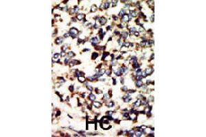 Formalin-fixed and paraffin-embedded human hepatocellular carcinoma tissue reacted with NEK7 polyclonal antibody  , which was peroxidase-conjugated to the secondary antibody, followed by DAB staining. (NEK7 Antikörper  (N-Term))