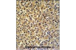 CRIP1 Antibody (C-term) (ABIN650905 and ABIN2839990) IHC analysis in formalin fixed and paraffin embedded bladder carcinoma followed by peroxidase conjugation of the secondary antibody and DAB staining. (CRIP1 Antikörper  (C-Term))