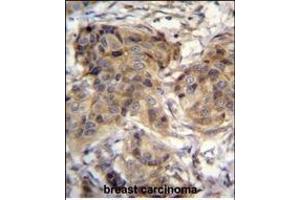 TTC9C Antibody (N-term) (ABIN655122 and ABIN2844752) immunohistochemistry analysis in formalin fixed and paraffin embedded human breast carcinoma followed by peroxidase conjugation of the secondary antibody and DAB staining. (TTC9C Antikörper  (N-Term))