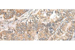 Immunohistochemistry of paraffin-embedded Human gastric cancer tissue using BCHE Polyclonal Antibody at dilution of 1:40(x200) (Butyrylcholinesterase Antikörper)