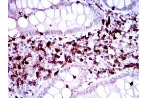 Immunohistochemical analysis of paraffin-embedded endometrial cancer tissues using CD7 mouse mAb with DAB staining. (CD7 Antikörper  (AA 72-175))