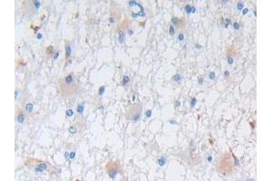 DAB staining on IHC-P; Samples: Human Glioma Tissue (Nestin Antikörper  (AA 178-399))