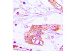 Immunohistochemical analysis of Apolipoprotein E staining in human lung cancer formalin fixed paraffin embedded tissue section. (APOE Antikörper  (Center))