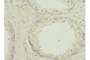 Immunohistochemistry of paraffin-embedded human prostate cancer using ABIN7154206 at dilution of 1:100 (PYGB Antikörper  (AA 6-843))