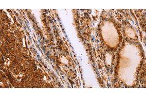 Immunohistochemistry of paraffin-embedded Human thyroid cancer tissue using SLC9A3R2 Polyclonal Antibody at dilution 1:40 (SLC9A3R2 Antikörper)