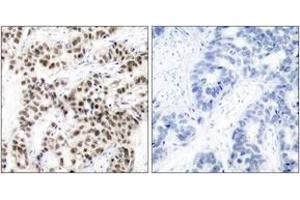 Immunohistochemistry analysis of paraffin-embedded human breast carcinoma tissue, using MYC (Ab-58) Antibody. (c-MYC Antikörper  (AA 25-74))