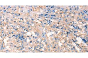 Immunohistochemistry of paraffin-embedded Human thyroid cancer using PRPS1/2/PRPS1L1 Polyclonal Antibody at dilution of 1:30 (PRPS1/2/1L1 Antikörper)
