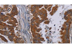 Immunohistochemistry of paraffin-embedded Human esophagus cancer tissue using NECTIN3 Polyclonal Antibody at dilution 1:40 (nectin-3 Antikörper)