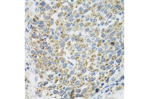 Immunohistochemistry of paraffin-embedded human lung cancer using TXN2 antibody (ABIN2560616) at dilution of 1:100 (40x lens). (TXN2 Antikörper)