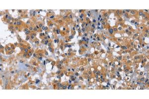 Immunohistochemistry of paraffin-embedded Human thyroid cancer using IL2RB Polyclonal Antibody at dilution of 1:30 (IL2 Receptor beta Antikörper)