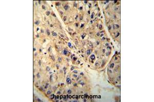 ABCD1 antibody immunohistochemistry analysis in formalin fixed and paraffin embedded human hepatocarcinoma followed by peroxidase conjugation of the secondary antibody and DAB staining. (ABCD1 Antikörper  (AA 257-285))