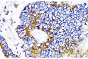 Immunohistochemistry of paraffin-embedded Human colon carcinoma using MRPL13 Polyclonal Antibody at dilution of 1:100 (40x lens). (MRPL13 Antikörper)