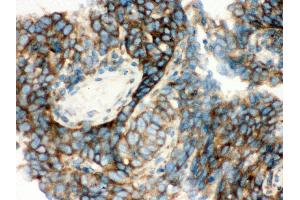 Anti- YB1 Picoband antibody,IHC(P) IHC(P): Human Lung Cancer Tissue (YBX1 Antikörper  (C-Term))