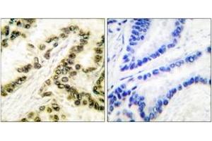 Immunohistochemistry analysis of paraffin-embedded human lung carcinoma tissue, using AP-2 Antibody. (TFAP2A Antikörper  (AA 388-437))
