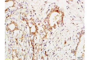Formalin-fixed and paraffin embedded human breast cancer labeled with Anti-CA153/MUC1/KL-6 Polyclonal Antibody, Unconjugated  at 1:200 followed by conjugation to the secondary antibody and DAB staining. (MUC1 Antikörper  (AA 1101-1255))