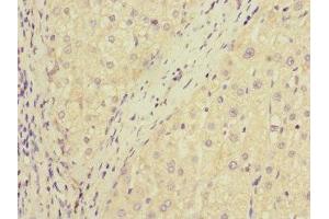 Immunohistochemistry of paraffin-embedded human liver cancer using ABIN7150741 at dilution of 1:100 (DUSP1 Antikörper  (AA 1-300))