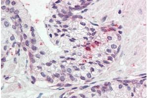 Human Prostate (formalin-fixed, paraffin-embedded) stained with KLK11 antibody ABIN337038 at 5 ug/ml followed by biotinylated goat anti-rabbit IgG secondary antibody ABIN481713, alkaline phosphatase-streptavidin and chromogen. (Kallikrein 11 Antikörper  (AA 68-82))