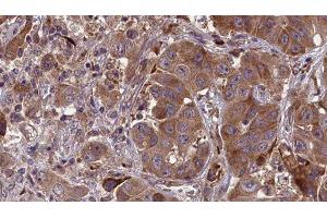 ABIN6277654 at 1/100 staining Human liver cancer tissue by IHC-P. (MLKL Antikörper  (Internal Region))