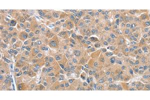 Immunohistochemistry of paraffin-embedded Human liver cancer tissue using CHMP4B Polyclonal Antibody at dilution 1:40 (CHMP4B Antikörper)