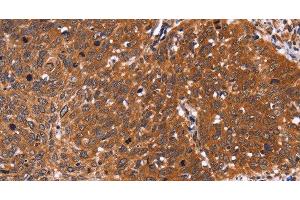 Immunohistochemistry of paraffin-embedded Human cervical cancer tissue using CDC37L1 Polyclonal Antibody at dilution 1:60 (CDC37L1 Antikörper)