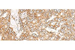 Immunohistochemistry of paraffin-embedded Human liver cancer tissue using NME4 Polyclonal Antibody at dilution of 1:45(x200) (NME4 Antikörper)