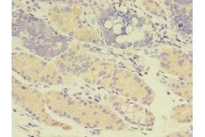 Immunohistochemistry of paraffin-embedded human gastric cancer using ABIN7166957 at dilution of 1:100 (GDI2 Antikörper  (AA 1-445))