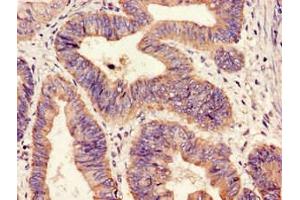 Immunohistochemistry of paraffin-embedded human colon cancer using ABIN7155869 at dilution of 1:100 (HIPK3 Antikörper  (AA 841-1130))