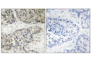 Immunohistochemistry analysis of paraffin-embedded human lung carcinoma tissue, using MAPK15 antibody. (MAPK15 Antikörper  (Internal Region))