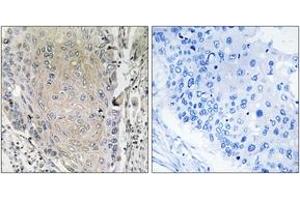Immunohistochemistry analysis of paraffin-embedded human lung carcinoma tissue, using CBLN3 Antibody. (CBLN3 Antikörper  (AA 131-180))