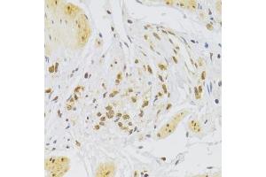Immunohistochemistry of paraffin-embedded human stomach using Slug Antibody (ABIN6127298, ABIN6148181, ABIN6148183 and ABIN6217314) at dilution of 1:100 (40x lens). (SLUG Antikörper  (AA 126-268))