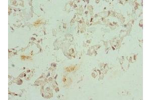 Immunohistochemistry of paraffin-embedded human bladder cancer using ABIN7148657 at dilution of 1:100 (CFDP1 Antikörper  (AA 1-299))